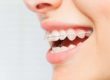 person smiling wanting ceramic braces