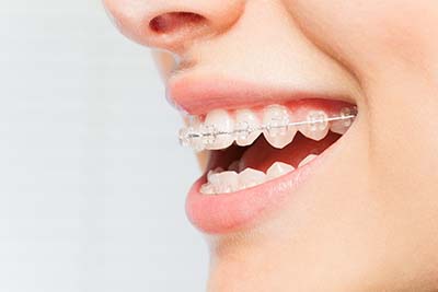 Woman’s smile with clear dental braces on teeth person smiling wanting ceramic braces