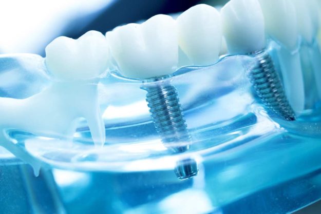 dental implants (2) a model of dental implants are shown