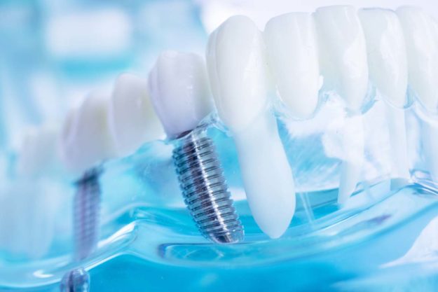 dental-implants (2) a model of dental implants