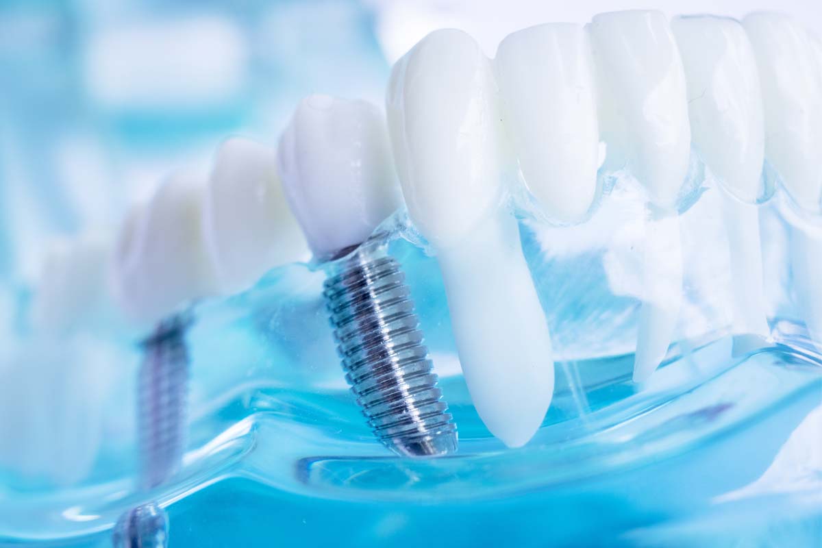 dental-implants (2) a model of dental implants