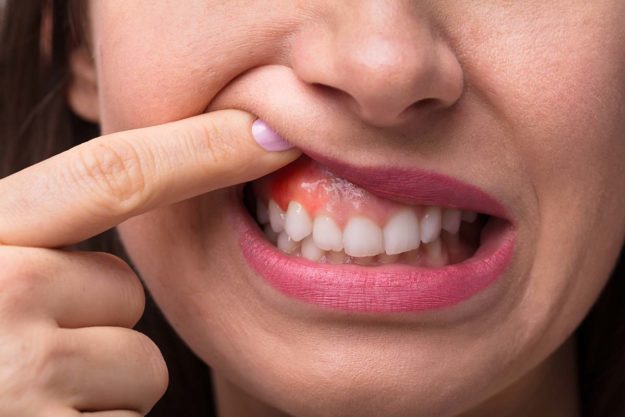 gums (3) person lifting lips to reveal gums