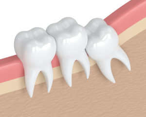 diagram of impacted teeth 