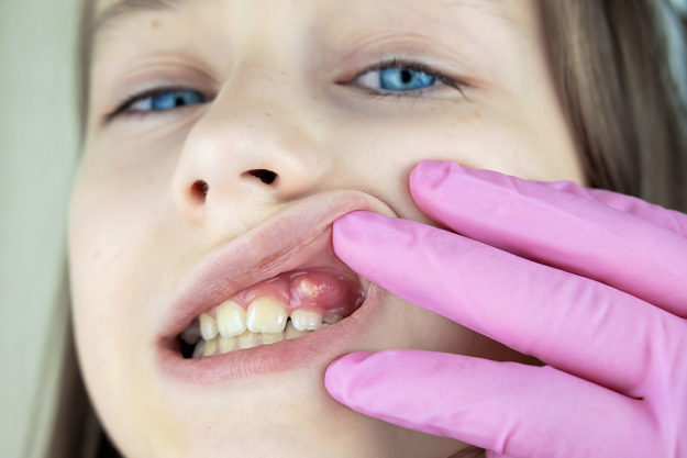 abscessed-tooth (1) And example of an abscessed tooth