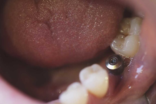 3-What-is-a-Single-Tooth-Implant (2) example of a single tooth implant