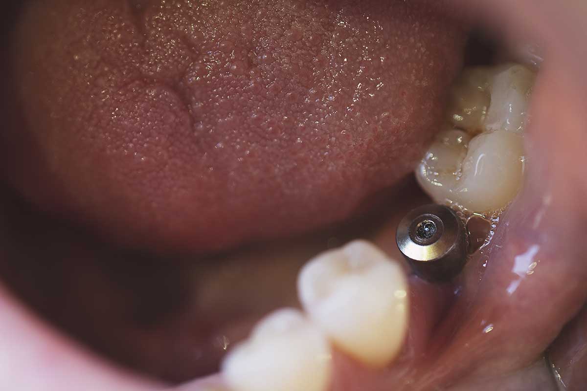 3-What-is-a-Single-Tooth-Implant (2) example of a single tooth implant