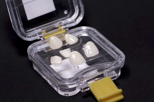 5 Benefits of Dental Veneers (1) example of dental veneers