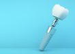 example of a dental implant