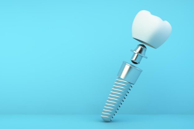 How Do Dental Implants Work (3) example of a dental implant